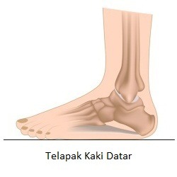 Telapak Kaki Datar