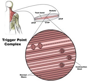 trigger point