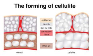 cellulit forming