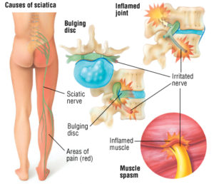 sciatica